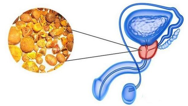 Calcinates in the prostate
