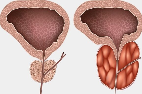 Prostatitis