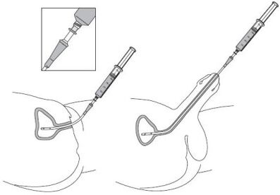 Immersion of the drug solution in the urethra