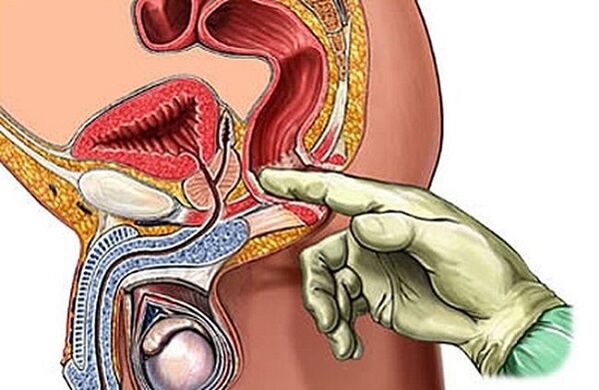 Prostate massage as a treatment for prostatitis