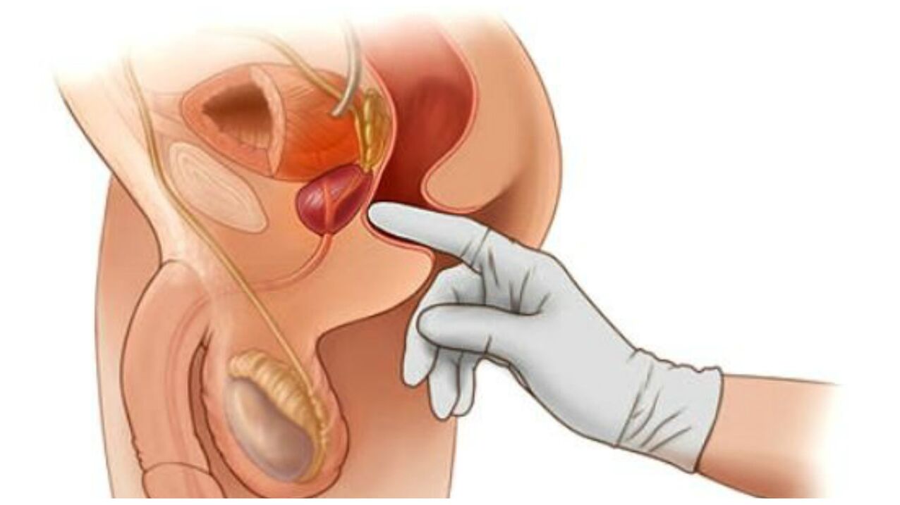 Prostate massage treats chronic prostatitis