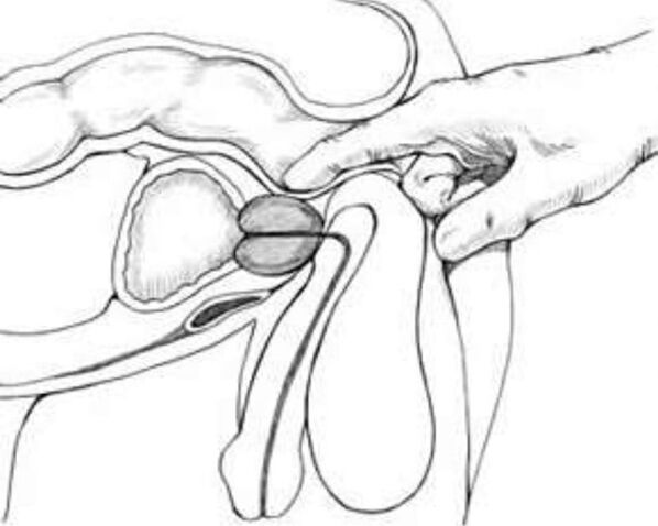 Prostate massage for prostatitis