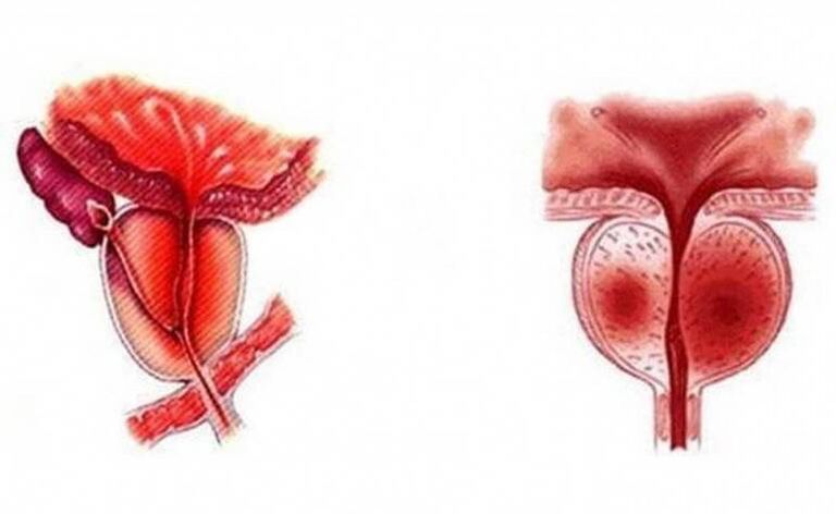 Acute prostatitis, which can become chronic