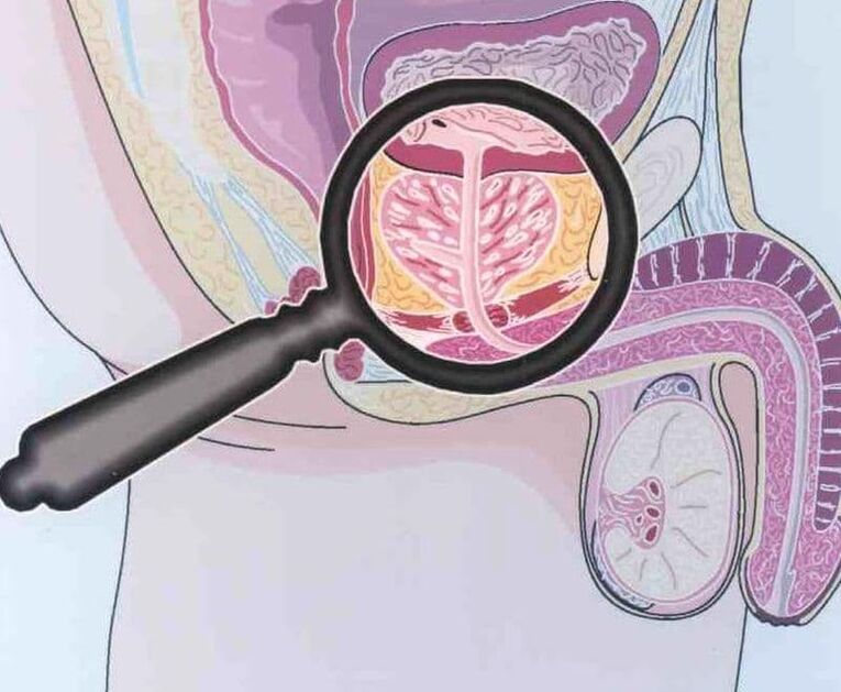 Beating prostate tissue in patients with chronic prostatitis in men