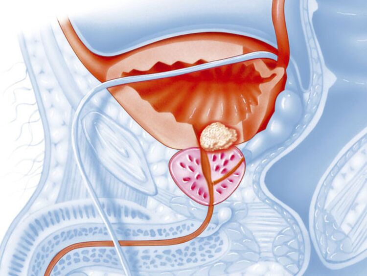 In chronic prostatitis, the urethral lumen narrows, making it difficult for urine to flow out. 